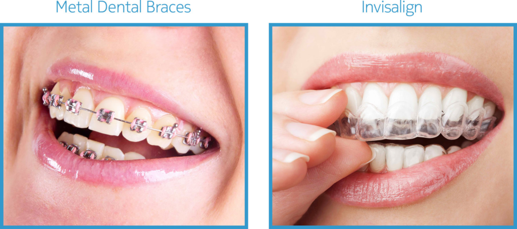 How Much Is Invisalign And Is It Worth It? - House of Orthodontia