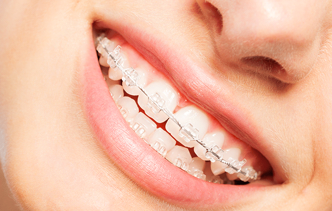 Orthodontics (Metal Braces / Invisalign) – Dental World Manila