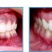 gum bleaching before and after