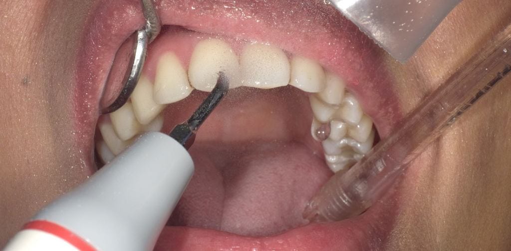 Oral Prophylaxis-compressed