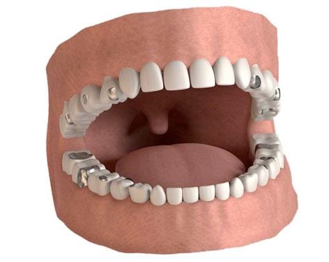 Restorative Dentistry -Tooth Bonding-compressed